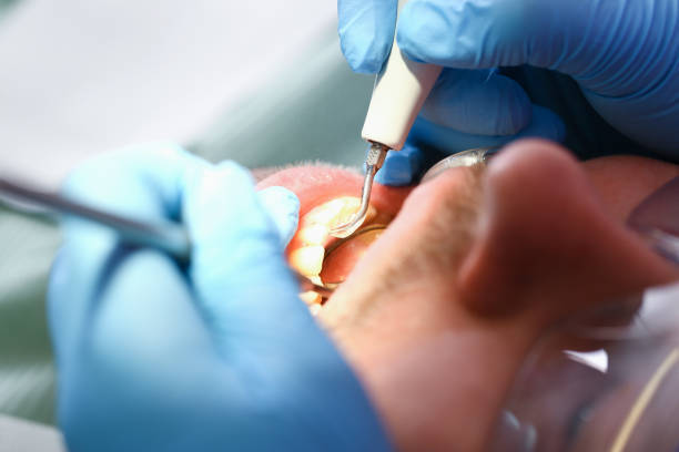 Best Emergency Wisdom Tooth Extraction in Forty Fort, PA